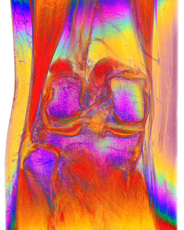 colorful image of an ACL xray